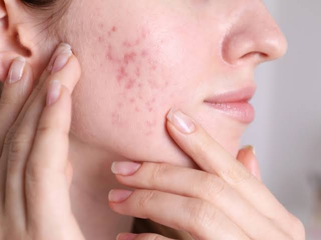 Acne scars that won't fade