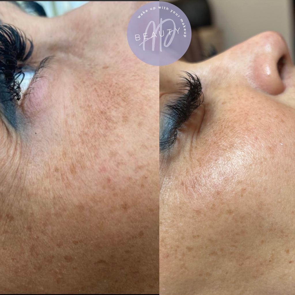 Before and after acne scarring improvement