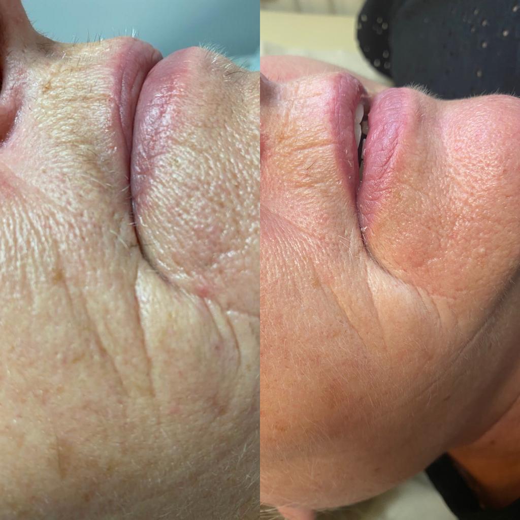 Before and after pigmentation improvement