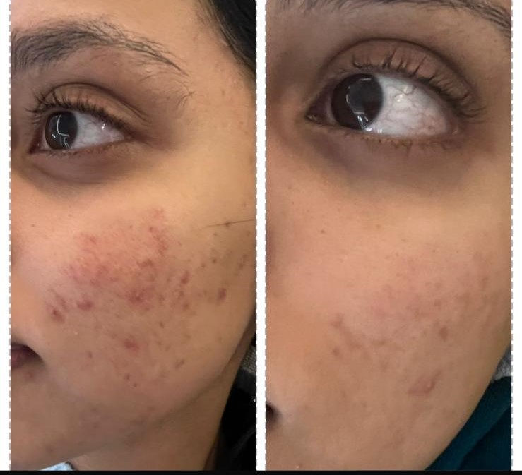 Recent client skin transformation result